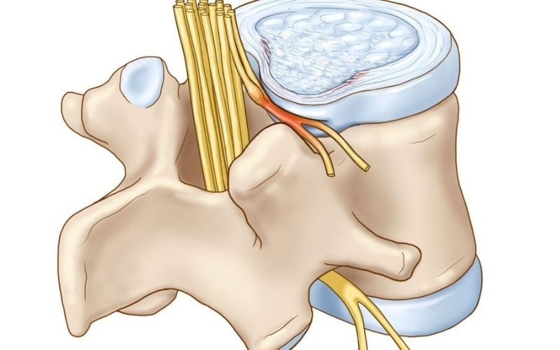 Dây thần kinh bị chèn ép gay đau đớn