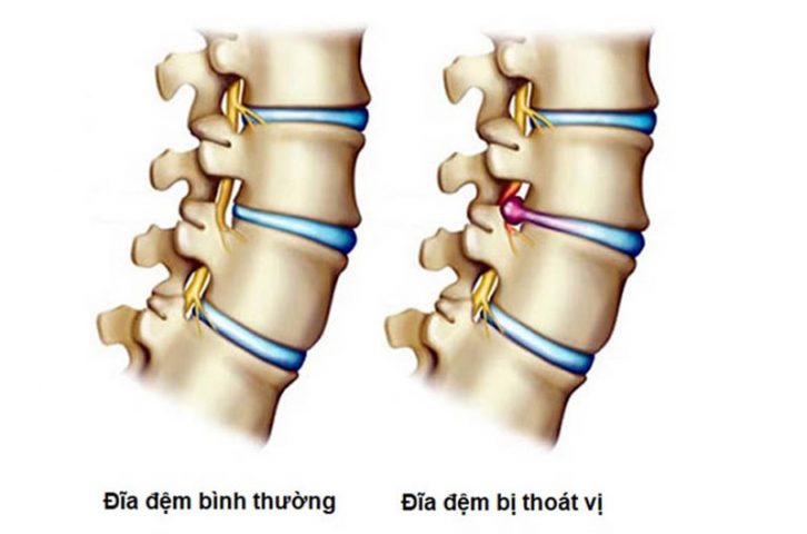 Thoát vị đĩa đệm L5 S1 - bệnh lý xương khớp nguy hiểm