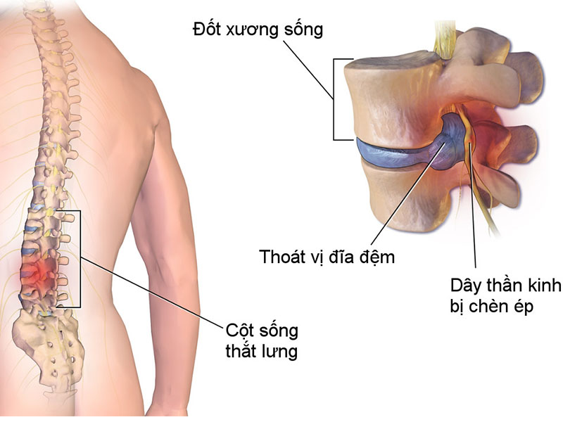 Bệnh nhân thoát vị đĩa đệm sẽ được kiểm tra chi tiết trước khi thực hiện tiêm ngoài màng cứng