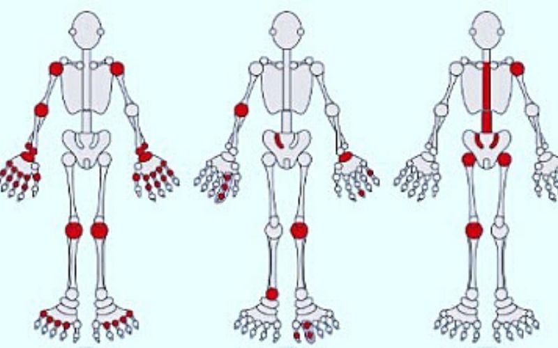 Dựa vào sự viêm đau ở các vị trí khớp để chẩn đoán