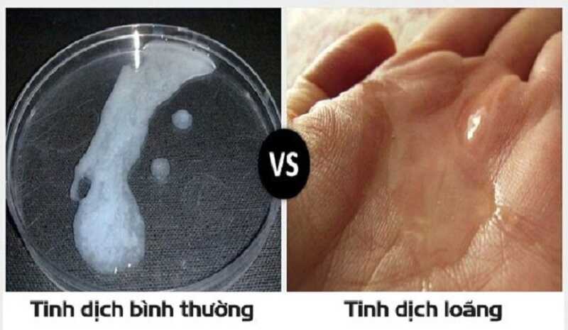 Phân biệt tinh trùng loãng và tinh trùng bình thường