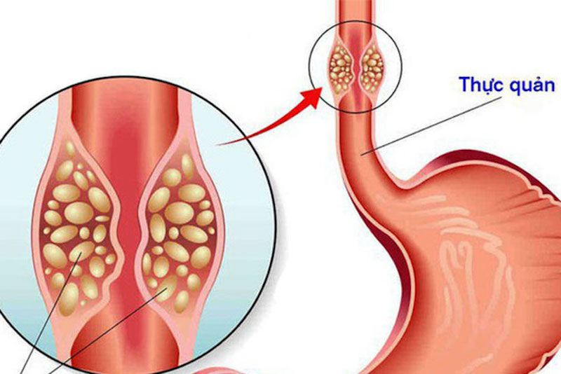 Biến chứng trào ngược dạ dày gây hẹp thực quản