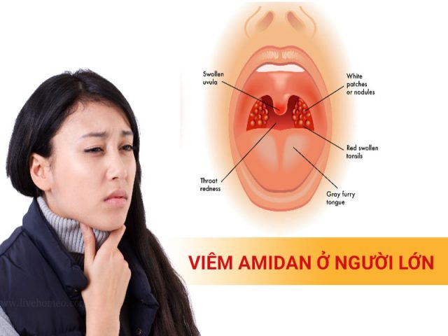 Viêm amidan ở người lớn - Nguy hiểm, Đừng xem nhẹ!