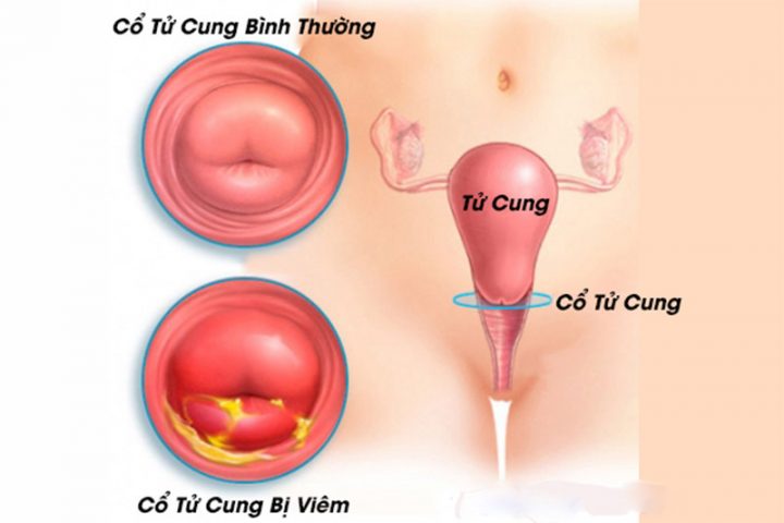 Nhiễm trùng cổ tử cung là một trong những bệnh lý phụ khoa nguy hiểm nhất