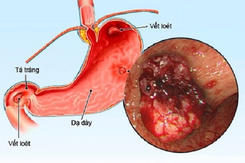 Viêm dạ dày là gì?