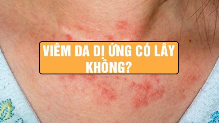 Viêm da dị ứng có lây không