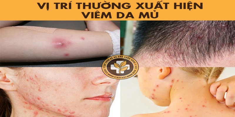 Vị trí thường xuất hiện viêm da mủ