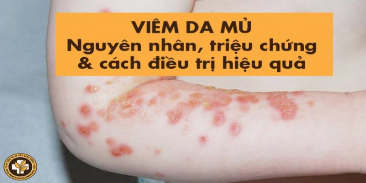 Viêm da mủ: Nguyên nhân, triệu chứng và cách điều trị hiệu quả