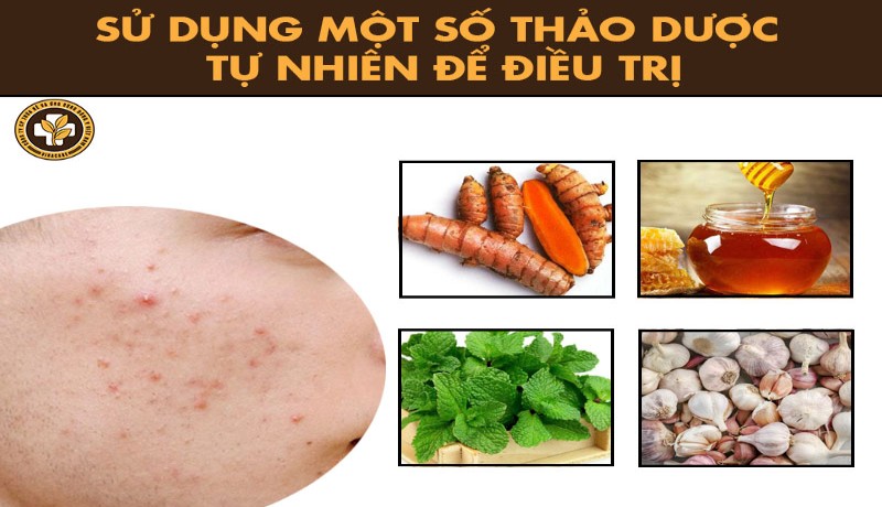 Sử dụng một số mẹo dân gian chữa viêm da mủ