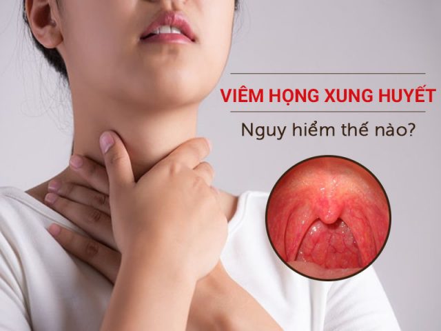 Viêm họng xung huyết - Nguy hiểm không thể bỏ qua