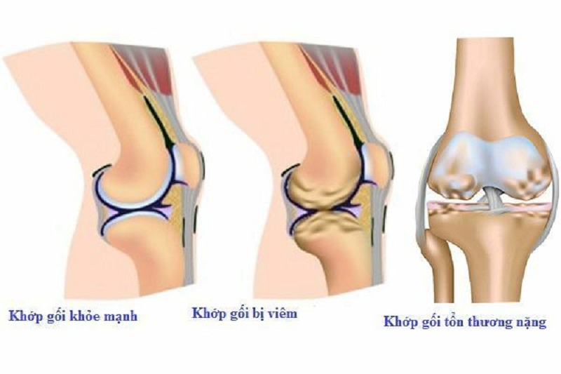 Khớp gối bị viêm do vi khuẩn