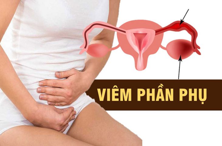 Viêm phần phụ: Dấu hiệu cảnh báo và phác đồ điều trị hiệu quả nhất