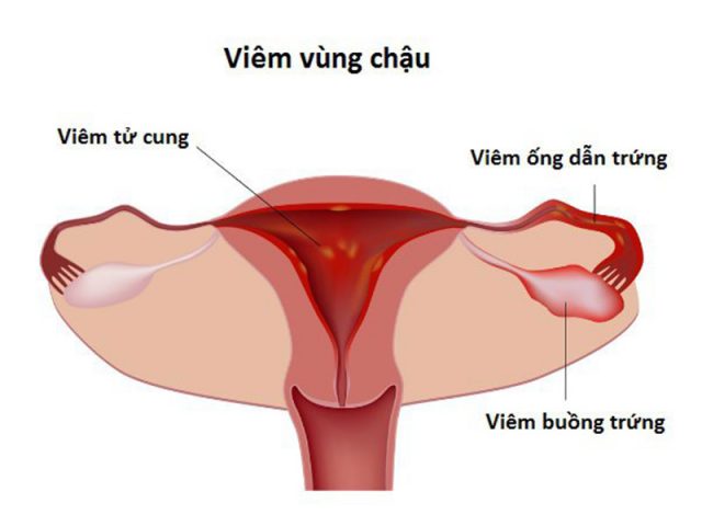 Viêm vùng chậu: Dấu hiệu nhận biết và Cách điều trị