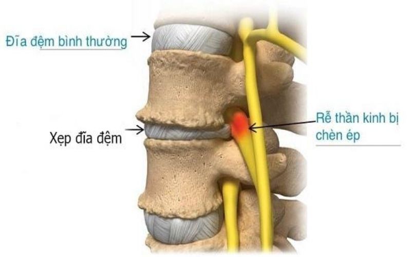 Hiện tượng xẹp đĩa đệm cột sống