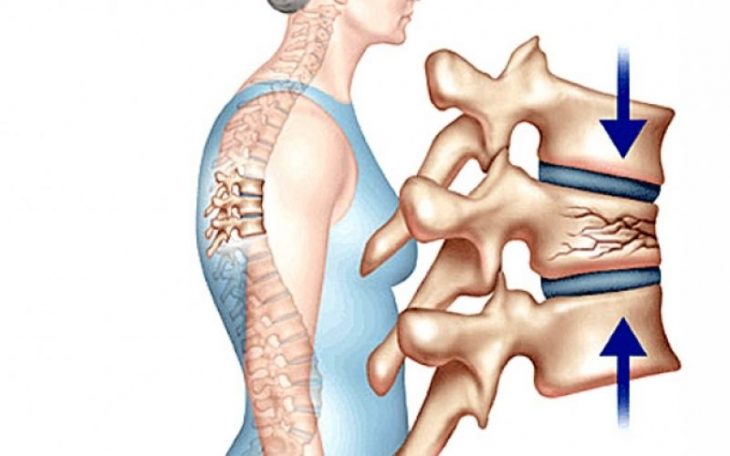 Xẹp đĩa đệm: Nguyên nhân, triệu chứng và hướng điều trị