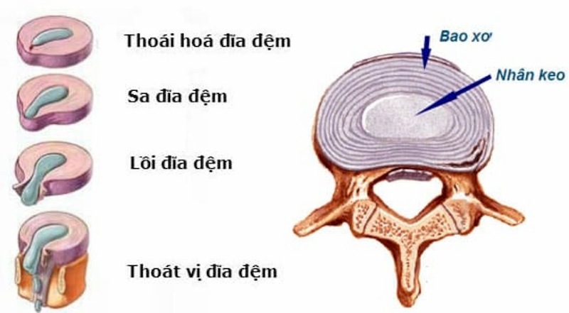 Lồi đĩa đệm L4 - L5 là một trong 4 giai đoạn bệnh thoát vị đĩa đệm