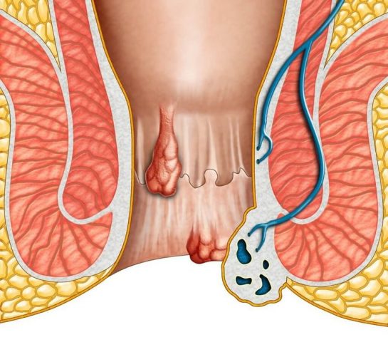 Hiện nay có nhiều người lựa chọn điều trị bệnh trĩ bằng phương pháp dân gian