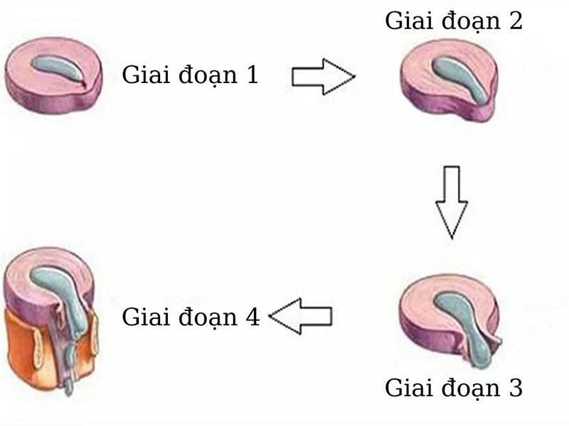 Nhận biết các giai đoạn thoát vị đĩa đệm có ý nghĩa quan trọng trong quá trình điều trị bệnh