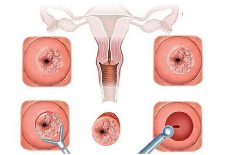 Các cấp độ của bệnh viêm lộ tuyến cổ tử cung 