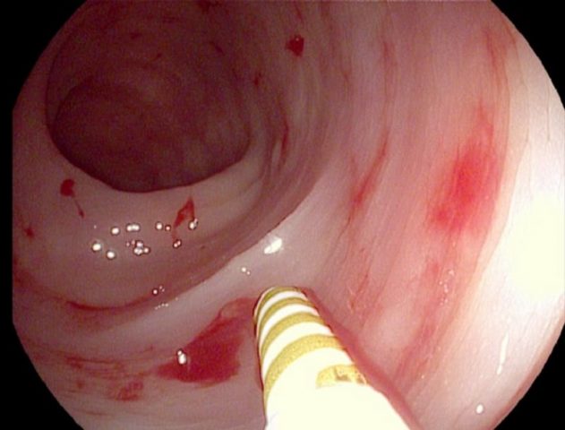 Điều trị xuất huyết tiêu hóa cần được tiến hành sớm để tránh biến chứng