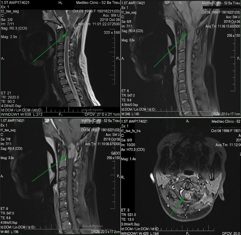 Hình ảnh chụp MRI đốt sống cổ