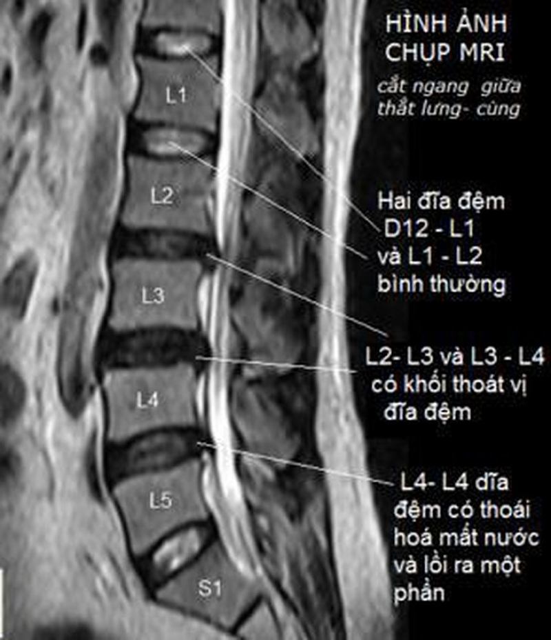 Hình ảnh đốt sống thắt lưng