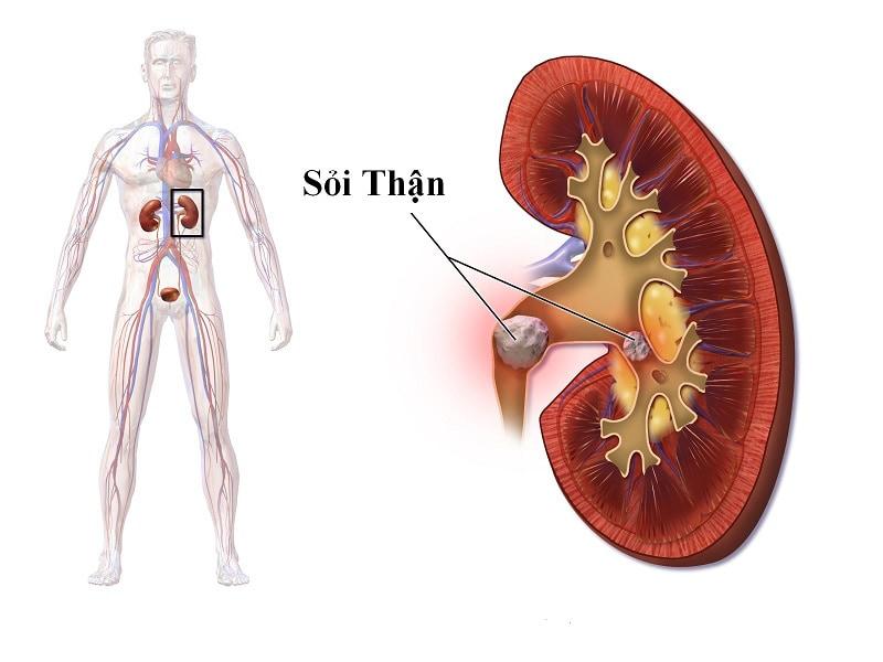 Chữa sỏi thận là tác dụng đặc trưng của kim tiền thảo