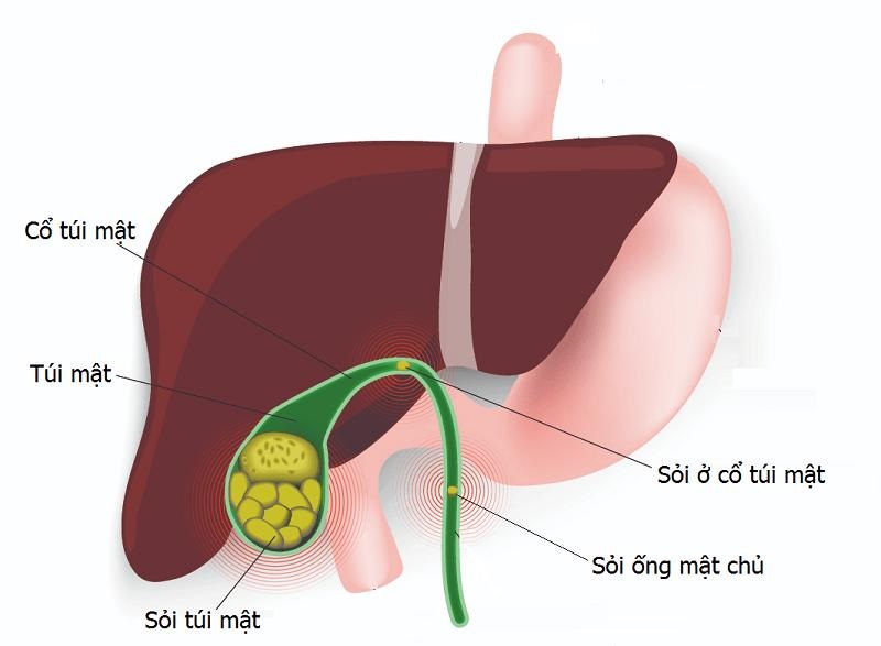 Dược liệu trị sỏi mật rất tốt