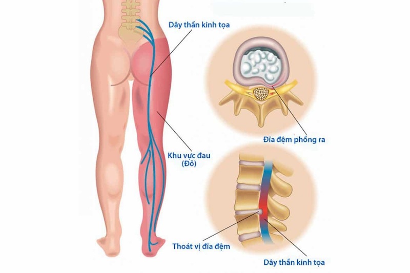 Tình trạng bệnh kéo dài sẽ dẫn đến bệnh thoát vị đĩa đệm hoặc một số biến chứng nguy hiểm khác