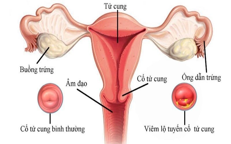 Thuốc được chỉ định cho bệnh nhân viêm lộ tuyến và các bệnh lý viêm nấm âm đạo liên quan