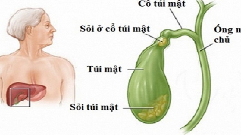 Sỏi đường mật là tình trạng kết sỏi trong mật gây đau và có thể dẫn đến biến chứng nguy hiểm