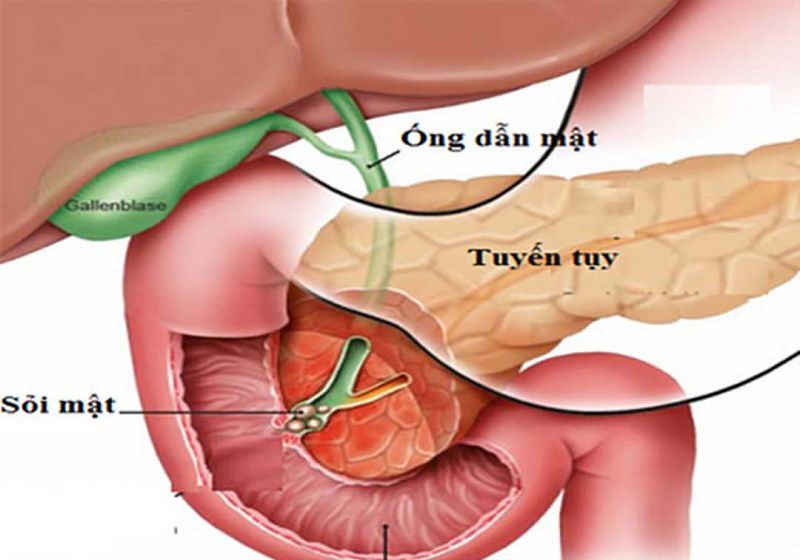 Có nhiều dạng sỏi được hình thành do các nguyên nhân khác nhau