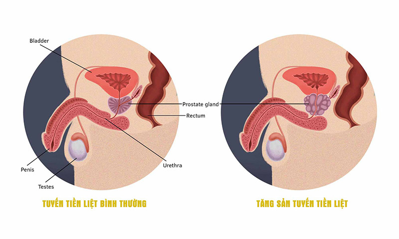 Tuyến tiền liệt bình thường và tuyến tiền liệt bị tăng sản