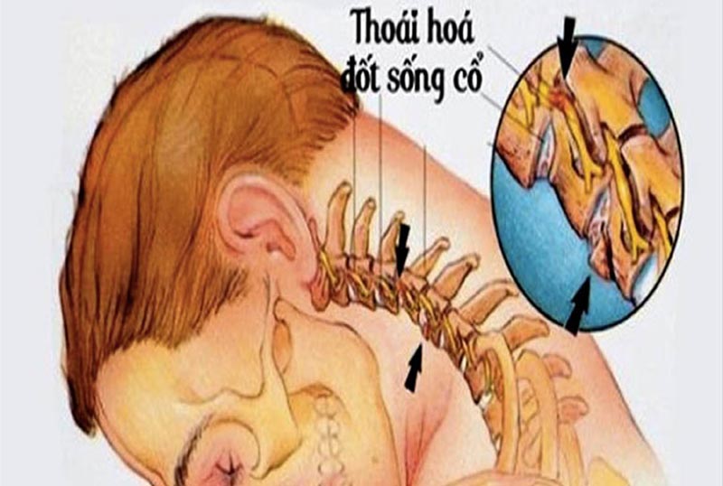 Thoái hóa đốt sống cổ gây cơn đau tức tại vùng cổ, vai gáy