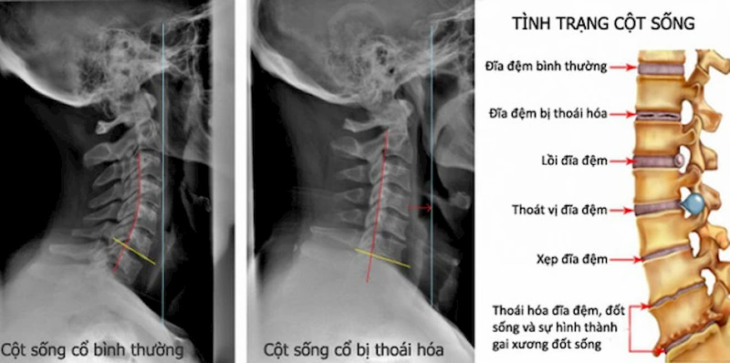 Thoái hóa đốt sống cổ là bệnh lý xương khớp tương đối nguy hiểm