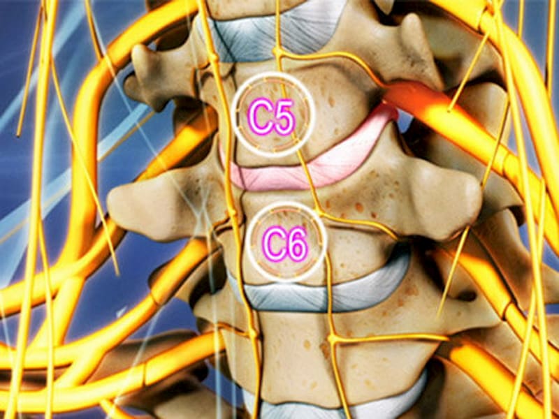 Chèn ép do thoái hóa cột sống