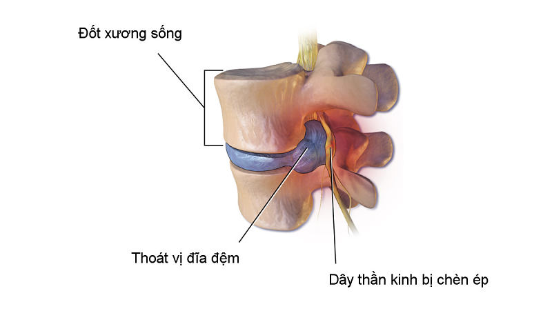 Chụp MRI thoát vị đĩa đệm nhằm phát hiện chính xác những tổn thương ở cột sống