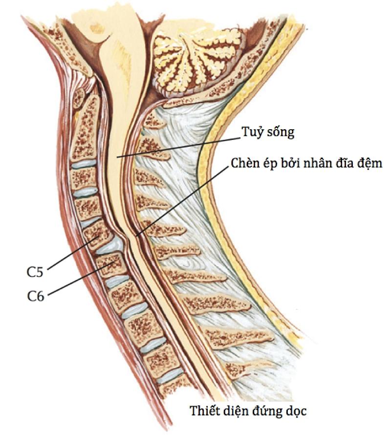 Thoát vị đĩa đệm cổ C5 C6 là căn bệnh thường gặp