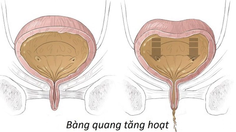 Bàng quang bị viêm làm nước tiểu hôi, khi đào thải có hiện tượng buốt