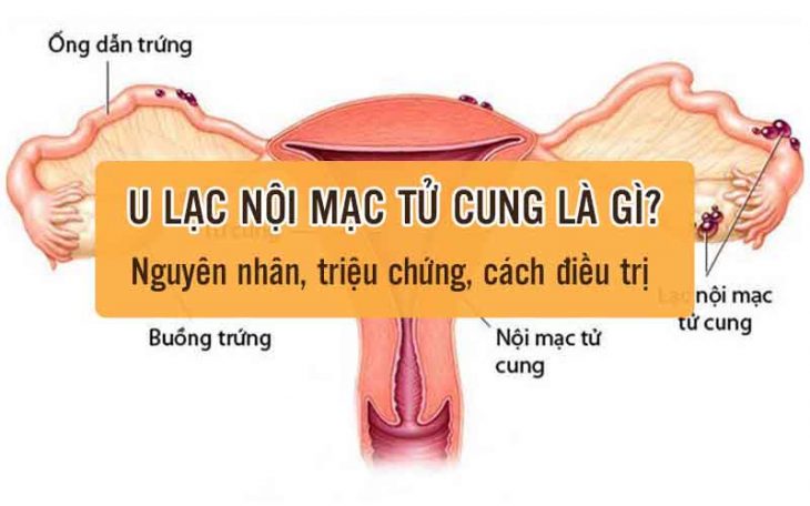 U lạc nội mạc tử cung có nguy hiểm không