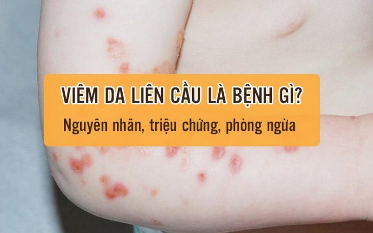 Viêm da liên cầu: Nguyên nhân, triệu chứng, phòng ngừa