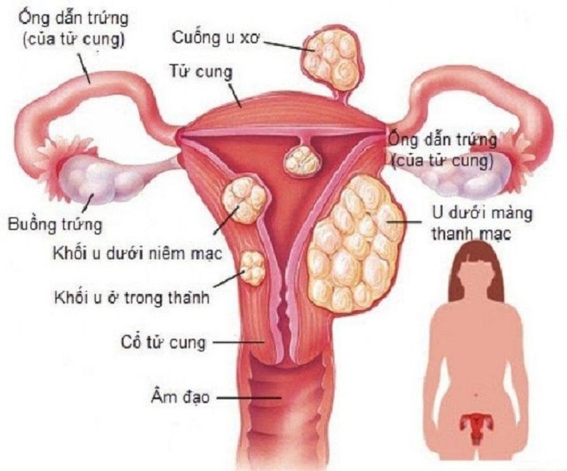 Viêm cổ tử cung sau sinh là chứng bệnh phổ biến ở các chị em.