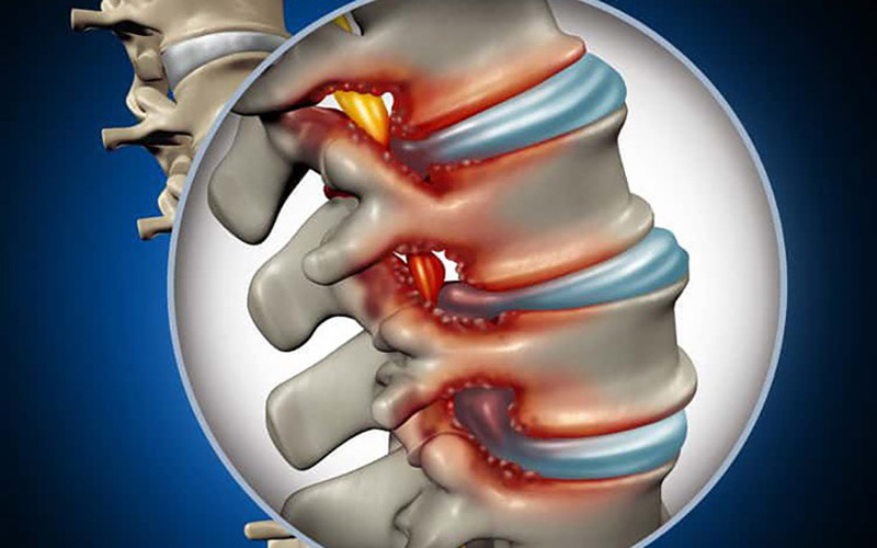 Gai cột sống: Nguyên nhân, triệu chứng và cách điều trị