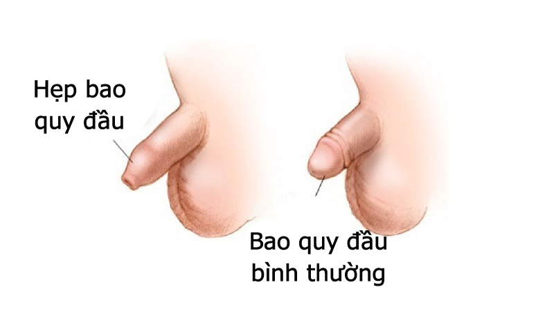 Tiểu rắt ở trẻ em là triệu chứng của bệnh hẹp bao quy đầu