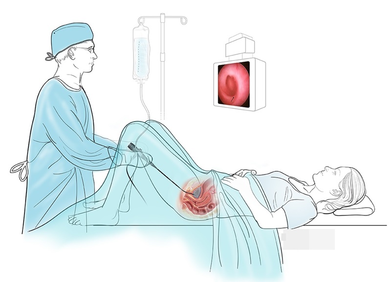 Người bệnh không được ăn uống vào đêm trước ngày thực hiện nội soi bàng quang