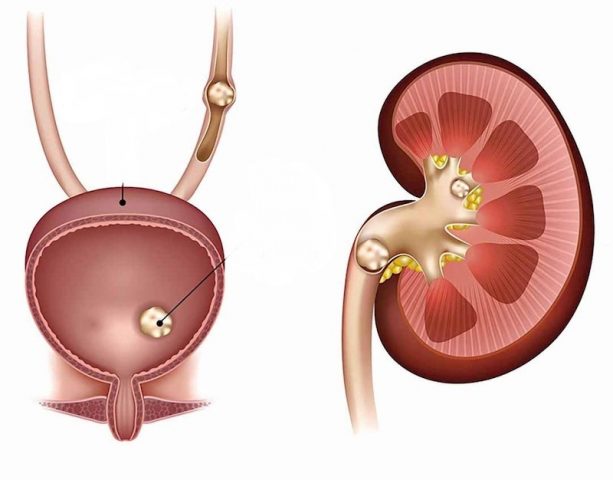 Sỏi bàng quang