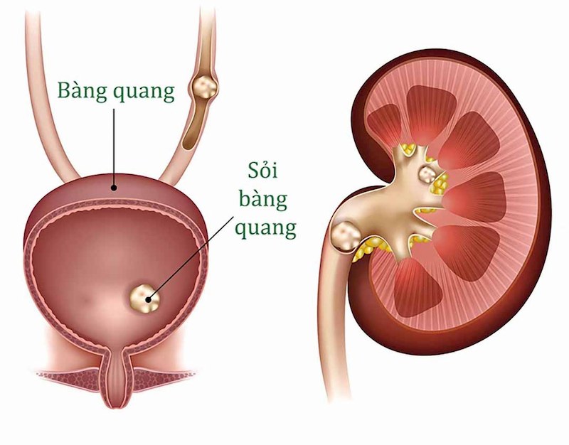 Sỏi bàng quang 5mm là kích thước sỏi nhỏ, có thể dễ dàng loại bỏ