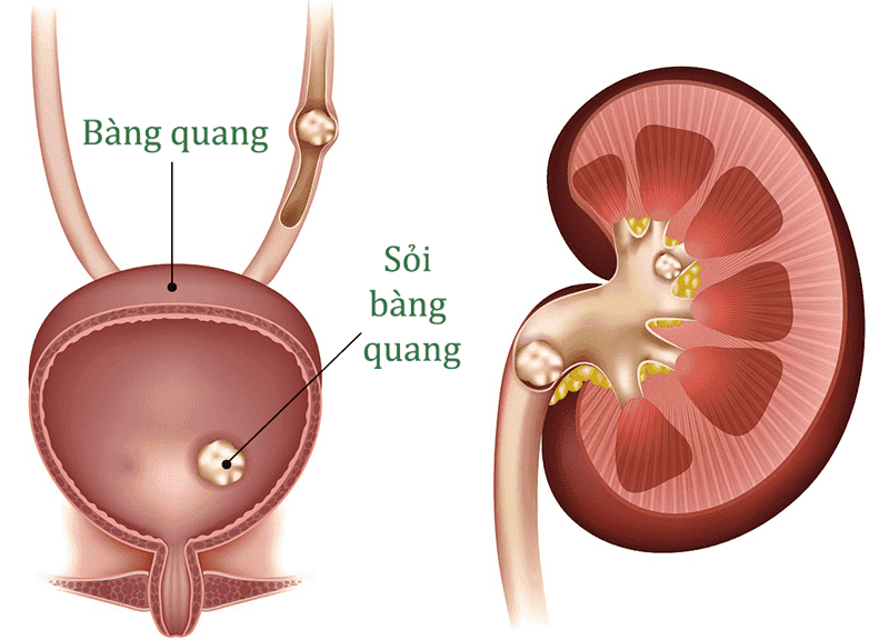 Thủ thuật này giúp phát hiện sỏi trong bàng quang