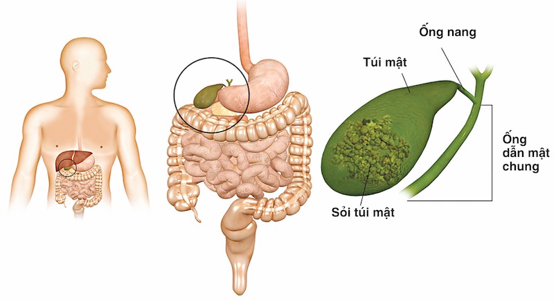 Sỏi bùn túi mật lâu ngày không điều trị khỏi có thể tích tụ thành sỏi mật