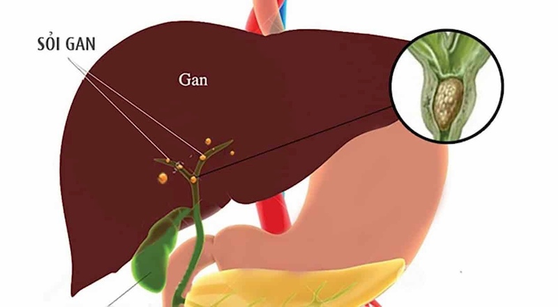 Sỏi đường mật trong gan là một trong những bệnh lý về gan thường gặp nhất hiện nay